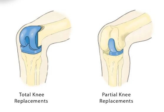 Difference Between Total Knee Replacement and Minimally-Invasive Partial Knee Replacement