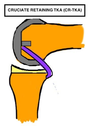 Cruciate Retaining Implants