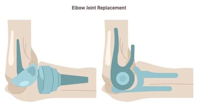 Understanding Elbow Replacement surgery