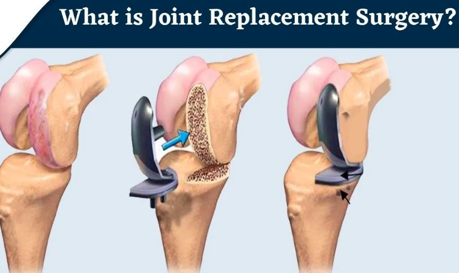 Latest Advancements in Joint Replacement Surgery: Dr. Vivek Logani