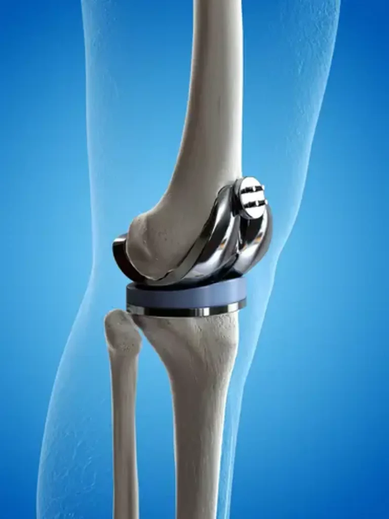 complications with knee replacement surgery