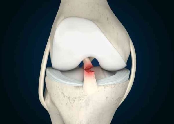 PCL Injury Treatment in gurgaon