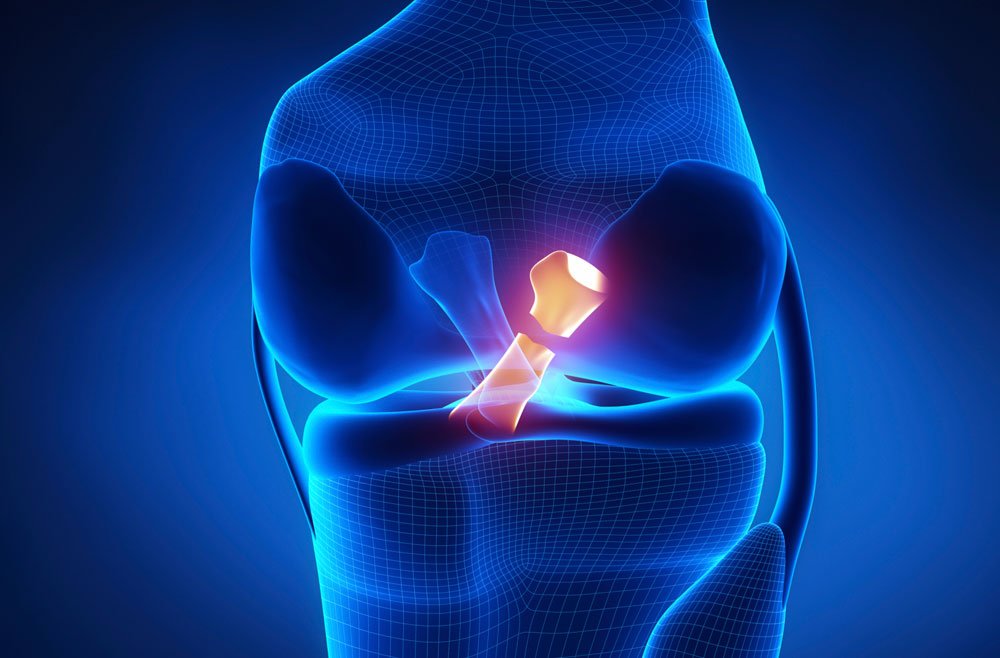 PCL Injury Treatment in gurgaon
