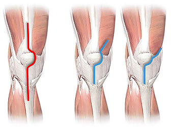 Best Minimally Invasive Knee Arthroplasty in Delhi NCR