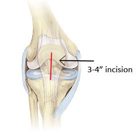 Best Minimally Invasive Knee Arthroplasty in Delhi NCR