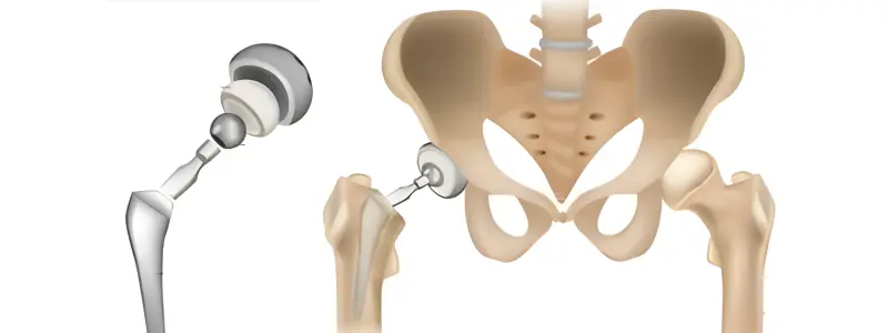 best knee replacement surgery in gurgaon