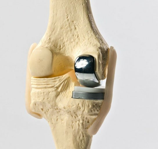 best partial knee replacement surgeon in Gurgaon