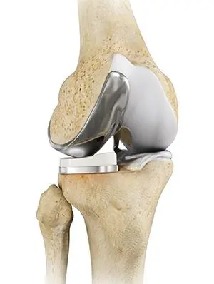 best partial knee replacement surgeon in Gurgaon